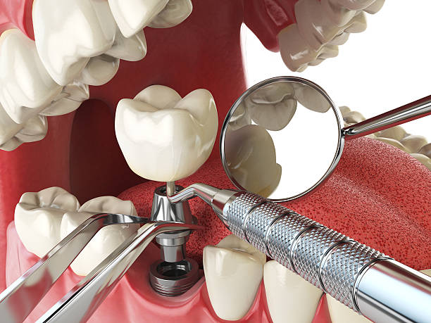 Best Emergency Dental Care for Broken or Chipped Teeth in New Castle, IN